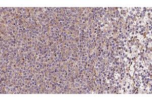 ABIN6273213 at 1/100 staining Human lymph cancer tissue by IHC-P. (COQ9 抗体  (Internal Region))