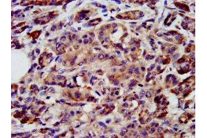 IHC image of ABIN7169389 diluted at 1:200 and staining in paraffin-embedded human pancreatic cancer performed on a Leica BondTM system. (PON3 抗体  (AA 269-335))