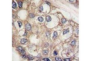 IHC analysis of FFPE human hepatocarcinoma tissue stained with AFP antibody