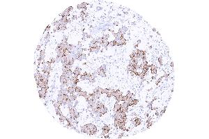 Epitheloid mesothelioma with membranous Upk3b staining of variable intensity in most tumor cells (Uroplakin 3B 抗体)