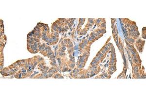 Immunohistochemistry of paraffin-embedded Human thyroid cancer tissue using SLAMF7 Polyclonal Antibody at dilution of 1:30(x200) (SLAMF7 抗体)