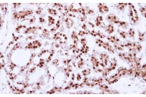 IHC-P Image Immunohistochemical analysis of paraffin-embedded human breast cancer, using CDC25C, antibody at 1:250 dilution. (CDC25C 抗体)