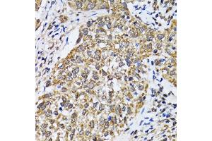 Immunohistochemistry of paraffin-embedded human lung cancer using TP53 antibody (ABIN5973383) at dilution of 1/100 (40x lens). (p53 抗体)