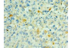 Immunohistochemistry of paraffin-embedded human melanoma using ABIN7169519 at dilution of 1:100 (SHC4 抗体  (AA 1-185))
