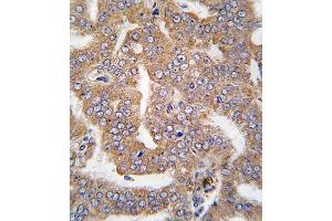 Formalin-fixed and raffin-embedded human prostata carcinoma tissue reacted with K4 antibody (N-term), which was peroxidase-conjugated to the secondary antibody, followed by DAB staining. (PAK4 抗体  (N-Term))