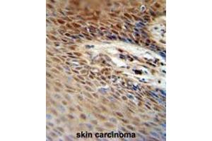 ZNF324B antibody (C-term) immunohistochemistry analysis in formalin fixed and paraffin embedded human skin carcinoma followed by peroxidase conjugation of the secondary antibody and DAB staining. (ZNF324B 抗体  (C-Term))