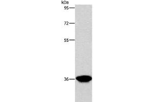 Western Blot analysis of Human liver cancer tissue using AKR1D1 Polyclonal Antibody at dilution of 1:650 (AKR1D1 抗体)