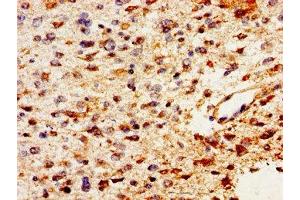 Immunohistochemistry of paraffin-embedded human glioma using ABIN7163691 at dilution of 1:100 (Pleiotrophin 抗体  (AA 33-168))