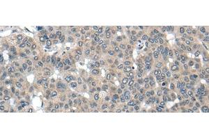 Immunohistochemistry of paraffin-embedded Human liver cancer tissue using CARD16 Polyclonal Antibody at dilution of 1:55(x200) (CARD16 抗体)