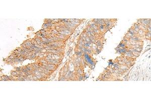 Immunohistochemistry of paraffin-embedded Human colorectal cancer tissue using GLIS1 Polyclonal Antibody at dilution of 1:50(x200) (GLIS1 抗体)