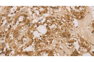 Immunohistochemistry of paraffin-embedded Human thyroid cancer tissue using DACH1 Polyclonal Antibody at dilution 1:50