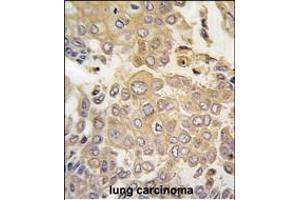 Forlin-fixed and paraffin-embedded hun lung carcino tissue reacted with PK4 antibody (N-term) (ABIN391465 and ABIN2837846) , which was peroxidase-conjugated to the secondary antibody, followed by DAB staining. (MAPK4 抗体  (N-Term))