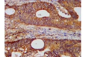 IHC image of ABIN7157562 diluted at 1:400 and staining in paraffin-embedded human colon cancer performed on a Leica BondTM system.