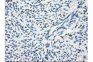 Immunohistochemical staining of paraffin-embedded Adenocarcinoma of colon tissue using anti-FRKmouse monoclonal antibody. (FRK 抗体)