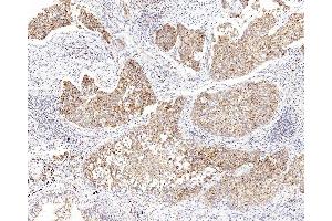 Immunohistochemistry analysis of paraffin-embedded human lung cancer using CYCS Polyclonal Antibody at dilution of 1:1000. (Cytochrome C 抗体)