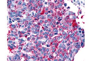 Anti-FZD8 / Frizzled 8 antibody IHC of human Lung, Non-Small Cell Carcinoma. (FZD8 抗体  (N-Term))