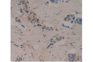 DAB staining on IHC-P Samples:Human Breast Cancer Tissue) (ENO2/NSE 抗体  (AA 1-434))