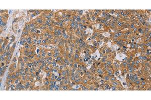 Immunohistochemistry of paraffin-embedded Human esophagus cancer using ACTN4 Polyclonal Antibody at dilution of 1:60 (alpha Actinin 4 抗体)