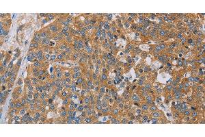 Immunohistochemistry of paraffin-embedded Human esophagus cancer using ACTN4 Polyclonal Antibody at dilution of 1:60