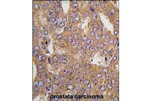 Formalin-fixed and paraffin-embedded human prostata carcinoma tissue reacted with NARS2 antibody , which was peroxidase-conjugated to the secondary antibody, followed by DAB staining.