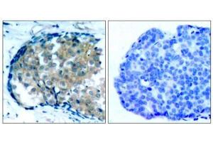 Immunohistochemical analysis of paraffin-embedded human breast carcinoma tissue, using Ezrin (phospho-Tyr353) antibody (E011063). (Ezrin 抗体  (pTyr353))