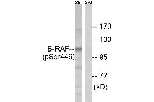 Immunohistochemistry analysis of paraffin-embedded human breast carcinoma tissue using B-RAF (Ab-446) antibody. (SNRPE 抗体  (Ser446))