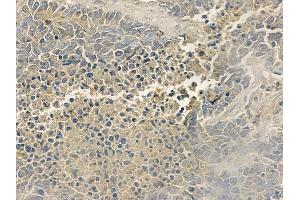 ABIN6255799 and ABIN6277803 at 1/100 staining human large cell lung carcinoma by IHC-P. (ERBB3 抗体  (pTyr1289))