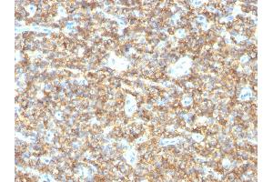 Formalin-fixed, paraffin-embedded human Ewing's Sarcoma stained with CD99 Mouse Monoclonal Antibody (HO36-1. (CD99 抗体)