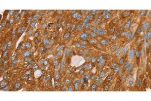 Immunohistochemistry of paraffin-embedded Human breast cancer using PAICS Polyclonal Antibody at dilution of 1:35 (PAICS 抗体)