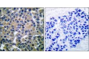 Immunohistochemistry analysis of paraffin-embedded human breast carcinoma tissue, using SYK (Ab-348) Antibody. (SYK 抗体  (AA 314-363))