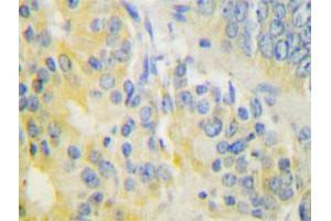 Immunohistochemical analysis of paraffin-embedded human prostate cancer tissue using CYP24A1 polyclonal antibody . (CYP24A1 抗体)
