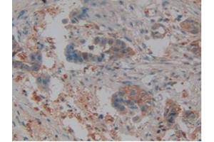 IHC-P analysis of Human Pancreas Cancer Tissue, with DAB staining. (Lipocalin 2 抗体  (AA 21-198))