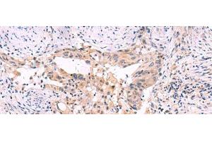 Immunohistochemistry of paraffin-embedded Human cervical cancer tissue using SLC12A5 Polyclonal Antibody at dilution of 1:40(x200) (KCC2 抗体)