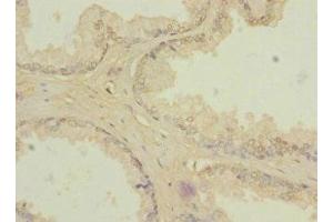Immunohistochemistry of paraffin-embedded human prostate cancer using ABIN7176633 at dilution of 1:100 (ZIC3 抗体  (AA 1-240))