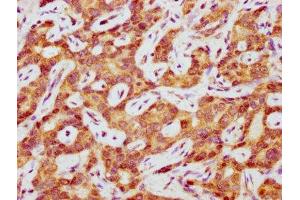 IHC image of ABIN7155027 diluted at 1:400 and staining in paraffin-embedded human liver cancer performed on a Leica BondTM system. (LIPC 抗体  (AA 23-217))