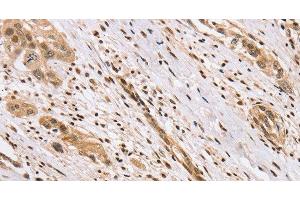Immunohistochemistry of paraffin-embedded Human esophagus cancer using CENPV Polyclonal Antibody at dilution of 1:40 (CENPV 抗体)