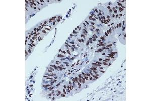 Immunohistochemistry of paraffin-embedded human colon carcinoma using ZBTB7A/FBI-1/LRF Rabbit mAb (ABIN7271439) at dilution of 1:100 (40x lens). (ZBTB7A 抗体)