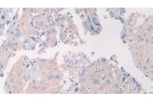 Detection of FLII in Human Breast cancer Tissue using Polyclonal Antibody to Flightless I Homolog (FLII) (FLII 抗体  (AA 896-1176))