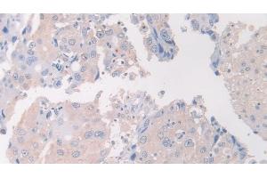 Detection of FLII in Human Breast cancer Tissue using Polyclonal Antibody to Flightless I Homolog (FLII) (FLII 抗体  (AA 896-1176))