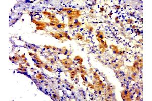 Paraformaldehyde-fixed, paraffin embedded human hepatocellular carcinoma tissue, Antigen retrieval by boiling in sodium citrate buffer(pH6) for 15min, Block endogenous peroxidase by 3% hydrogen peroxide for 30 minutes, Blocking buffer (normal goat serum) at 37°C for 20min, Antibody incubation with Rabbit Anti-C4orf51 Polyclonal Antibody, Unconjugated  at 1:500 overnight at 4°C, followed by a conjugated secondary and DAB staining (C4ORF51 抗体  (AA 1-100))