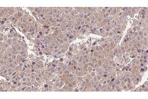 ABIN6276562 at 1/100 staining Human liver cancer tissue by IHC-P. (Glutamate Receptor 3 抗体)