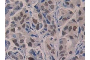 Detection of 5-LO in Human Breast cancer Tissue using Polyclonal Antibody to 5-Lipoxygenase (5-LO) (ALOX5 抗体  (AA 461-671))