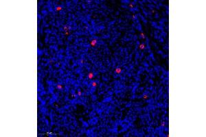 Immunofluorescence of paraffin embedded human endometrial cancer using CST9L (ABIN7073650) at dilution of 1:900 (300x lens) (CST9L 抗体)