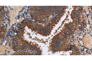 Immunohistochemistry of paraffin-embedded Human colon cancer tissue using LRRC57 Polyclonal Antibody at dilution 1:40 (LRRC57 抗体)