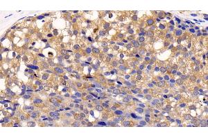 Detection of CTSK in Human Breast cancer Tissue using Polyclonal Antibody to Cathepsin K (CTSK) (Cathepsin K 抗体  (AA 71-319))
