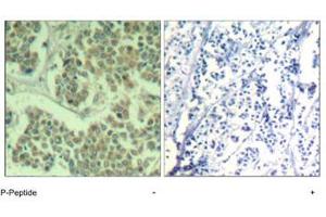 Immunohistochemical analysis of paraffin-embedded human breast carcinoma tissue using EIF2S1 (phospho S49) polyclonal antibody . (EIF2S1 抗体  (pSer49))