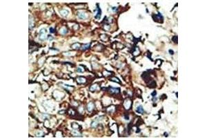 IHC testing of FFPE human breast cancer with PACSIN2 antibody at 1:50. (PACSIN2 抗体  (AA 342-371))