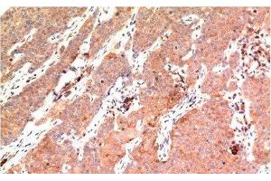 Immunohistochemistry of paraffin-embedded Human breast carcinoma tissue using Epsilon Tubulin Monoclonal Antibody at dilution of 1:200. (TUBE1 抗体)