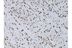 Immunohistochemistry of paraffin-embedded human uterine cancer using HUS1 antibody (ABIN6131776, ABIN6142084, ABIN6142086 and ABIN6218116) at dilution of 1:100 (40x lens). (HUS1 抗体  (AA 1-280))