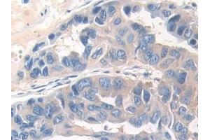 Detection of DOK3 in Human Breast cancer Tissue using Polyclonal Antibody to Docking Protein 3 (DOK3) (DOK3 抗体  (AA 128-385))